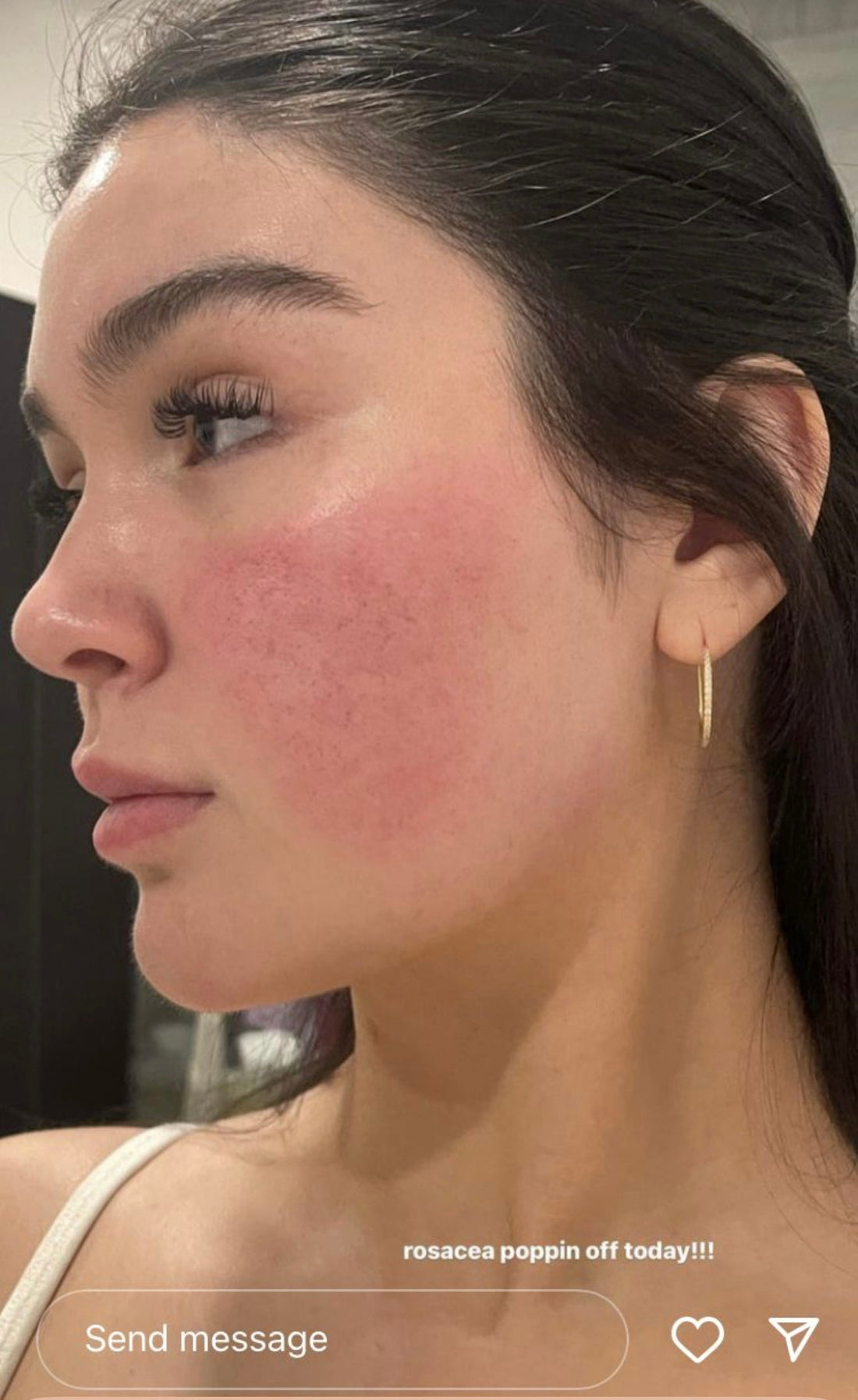 female experiencing a rosacea flare up
