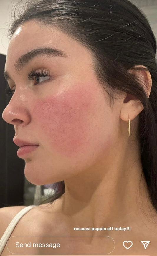 female experiencing a rosacea flare up